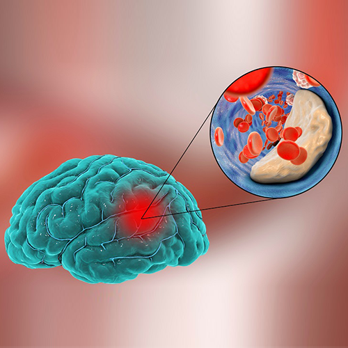 NEUROLOGICAL-CONDITIONS-2-CROPPED NEUROLOGICAL-CONDITIONS-2-CROPPED